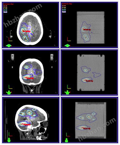 Cirs 037多病变脑QA模型